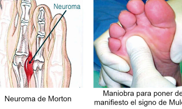 A tu salud: Neuroma de Morton: Una enfermedad “Real”