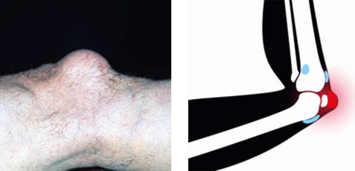 Bursitis Prerrotuliana: La Rodilla de la Beata